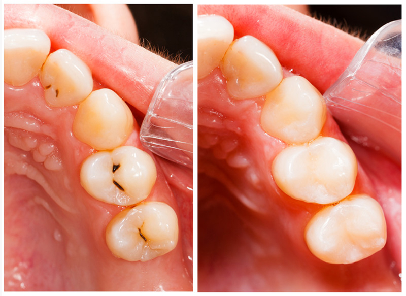 Fillings Watkinsville, GA