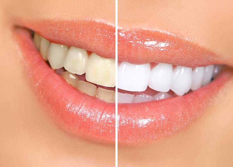 Teeth Whitening Watkinsville, GA